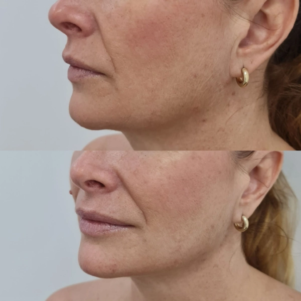 Resultado lipolaser papada endolaser mentón antes después Málaga — IME Málaga
