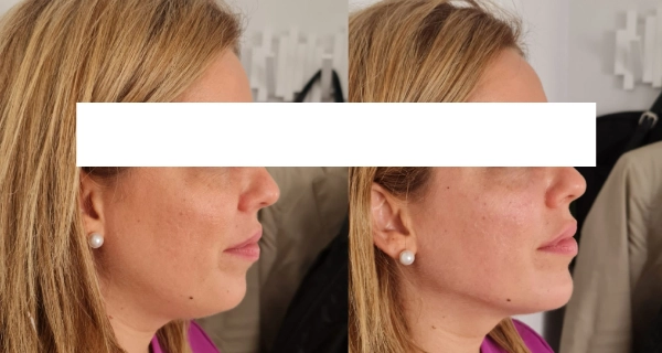 Resultado endolaser mentón lipolaser papada Málaga — Dr. Herrera Vila IME Málaga
