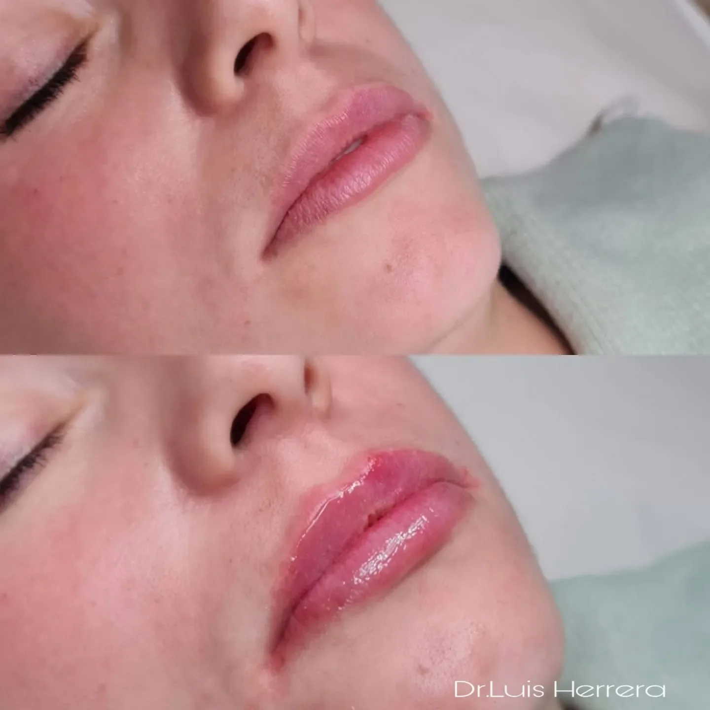 Resultado aumento de labios con ácido hialurónico Málaga — Dr. Luis Fidel Herrera Vila