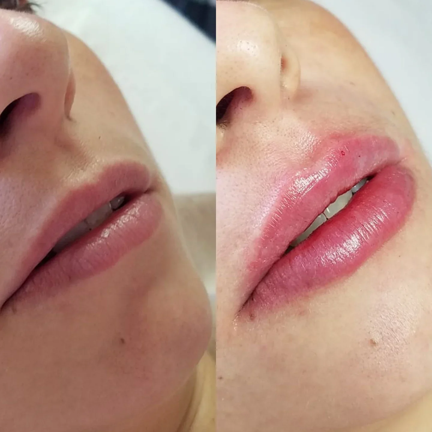 Antes y después aumento labios ácido hialurónico Málaga — Dr. Herrera Vila