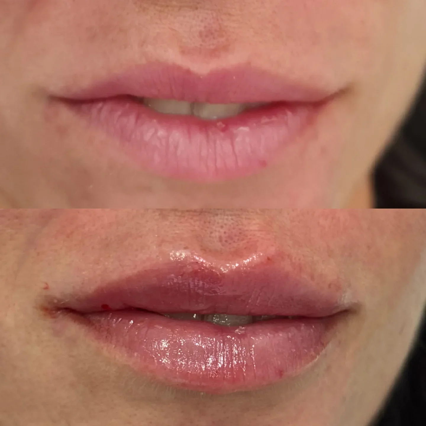 Perfilado y aumento labios Málaga ácido hialurónico — Dr. Herrera Vila