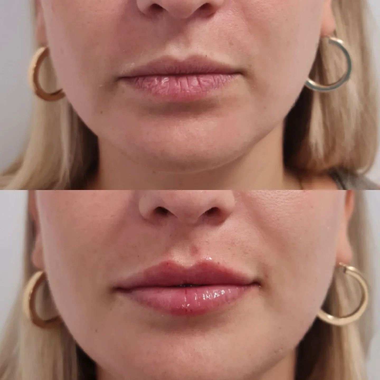 Resultado labios ácido hialurónico antes después Málaga — Dr. Herrera Vila