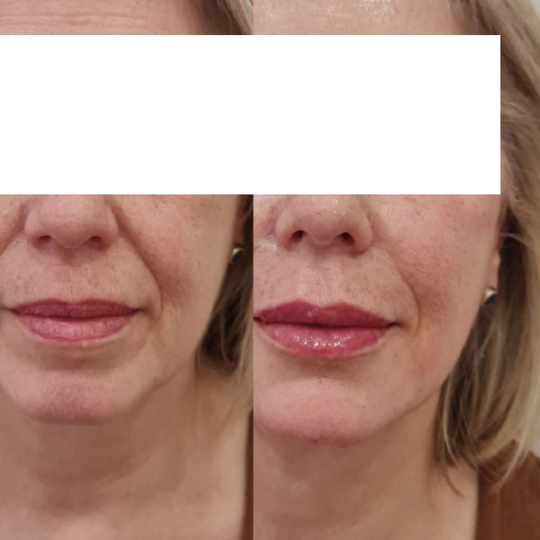 Resultado labios hialurónico antes después clínica estética Málaga — IME Málaga