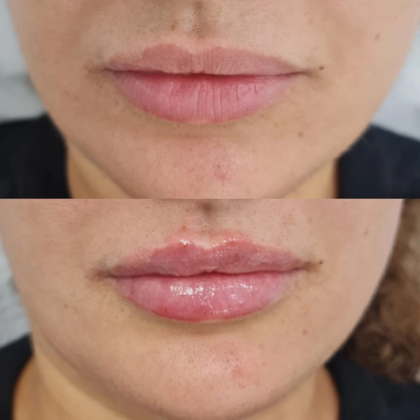Labios ácido hialurónico antes después Málaga Costa del Sol — IME Málaga