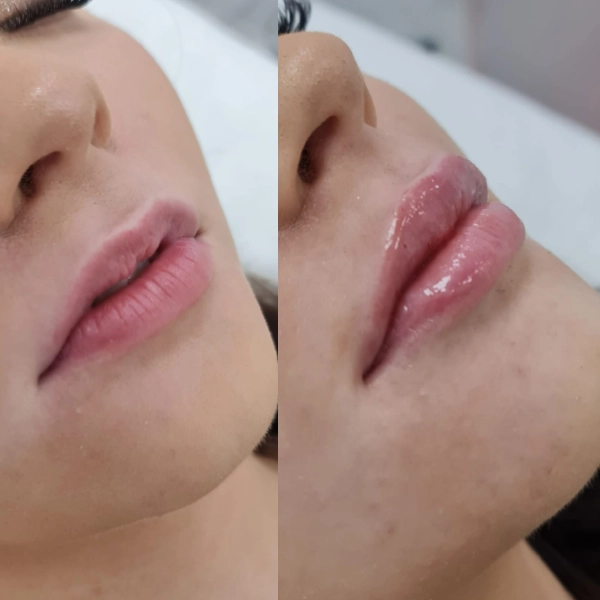 Aumento labios hialurónico resultado natural Málaga — Dr. Herrera Vila IME Málaga
