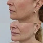 Resultado óvalo facial ácido hialurónico Málaga — Dr. Herrera Vila